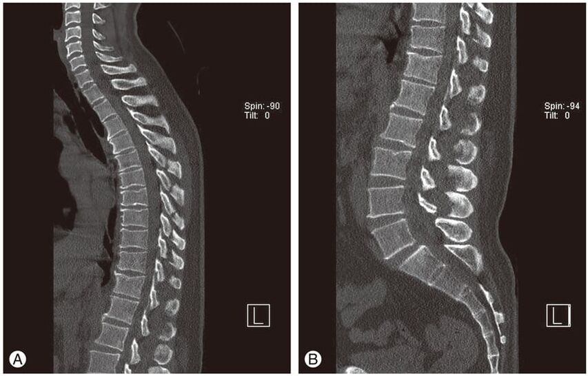 Orno arteko diskoen deformazioa MRI irudietan osteokondrosi torazikoan