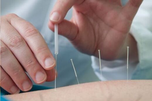 Akupuntura - osteokondrosiak eragindako gerrialdeko mina tratatzeko metodoa