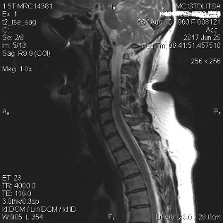 Osteochondrosis eta spondylosis de trápaga bizkarrezurra